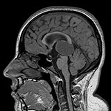 Pineoblastoma