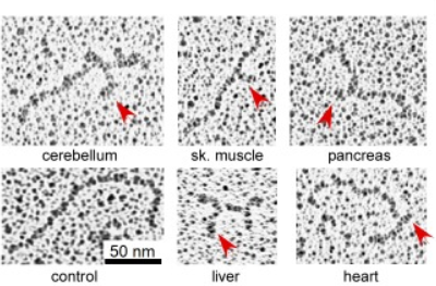 Illustration of slipped DNA structures formed at CTG trinucleotide repeats in the DM1 disease locus, detected in patient tissues.