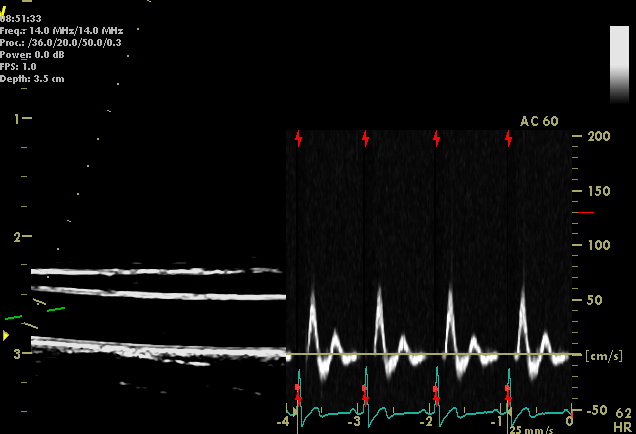 Composite image of the ultrasound assessment of the brachial artery.