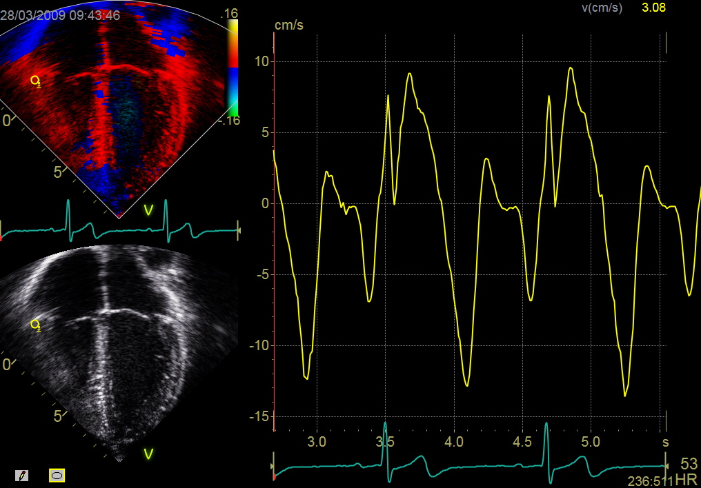 Composite image of the assessment of the lateral right ventricular wall using colour tissue Doppler.