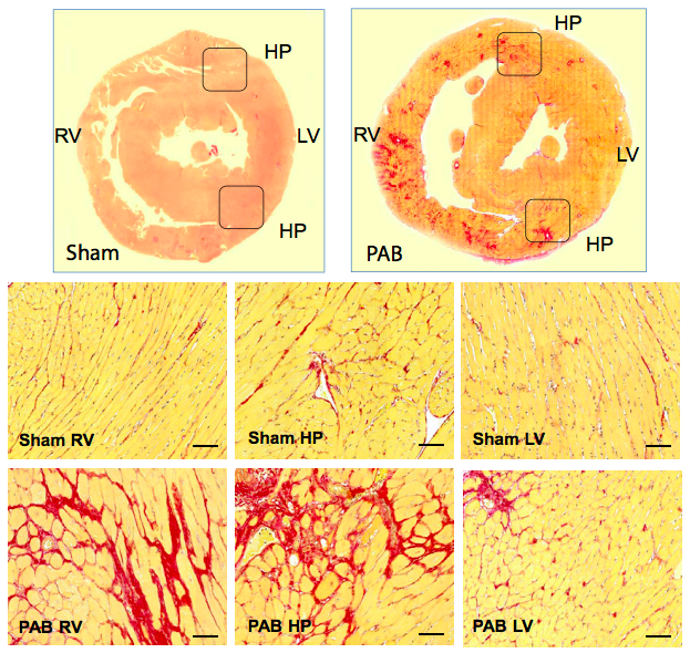Composite image of Representative Picrosirius red (PSR) staining of rat hearts 6 weeks after sham and pulmonary artery banding (PAB) procedures. PSR staining demonstrates that PAB-induced right ventricular (RV) pressure load is associated with a remarkable accumulation of PSR-positive collagen and myocyte hypertrophy in the RV and septal hinge-point (HP) regions.