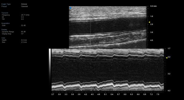 Still image of Radial artery M-Mode using Visualsonics, High Frequency Ultrasound