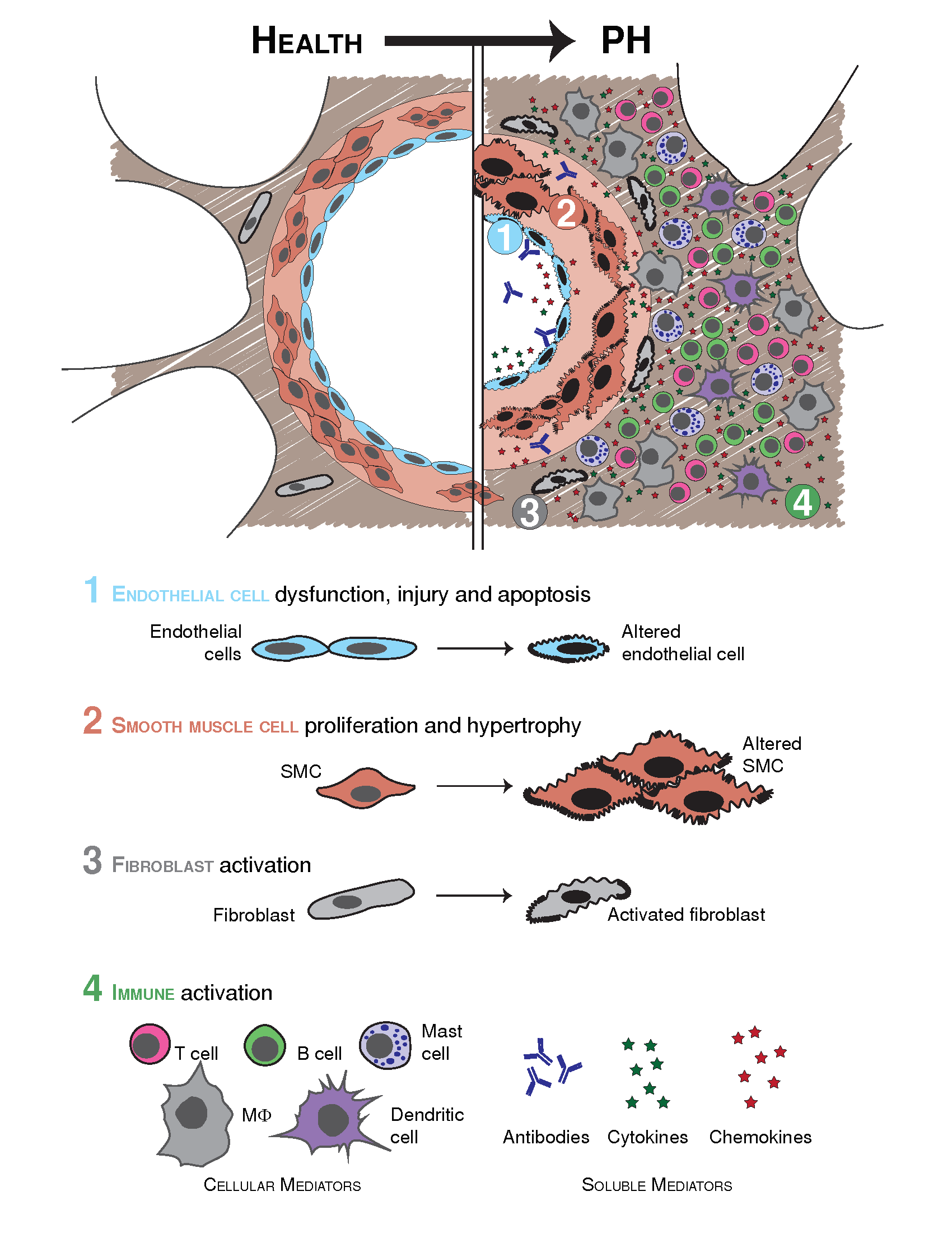 A scientific diagram illustrating that PAH is characterized by inflammation of the lung vasculature, involving virtually all subtypes of cells of the vascular wall, as well as mature immune lineages. Endothelial cells and smooth muscle cells proliferate, fibroblasts are activated, and immune cells invade the vessel wall.