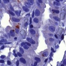 A microscopic image of purple-stained gastric epithelium from a patient infected with a VacA+ H. pylori. Small clusters of red dots represent intracellular H. pylori bacteria within gastric cells