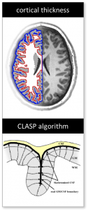 A graphic depicting the tissue boundaries of the brain, and how these boundaries are used to calculate grey matter thickness