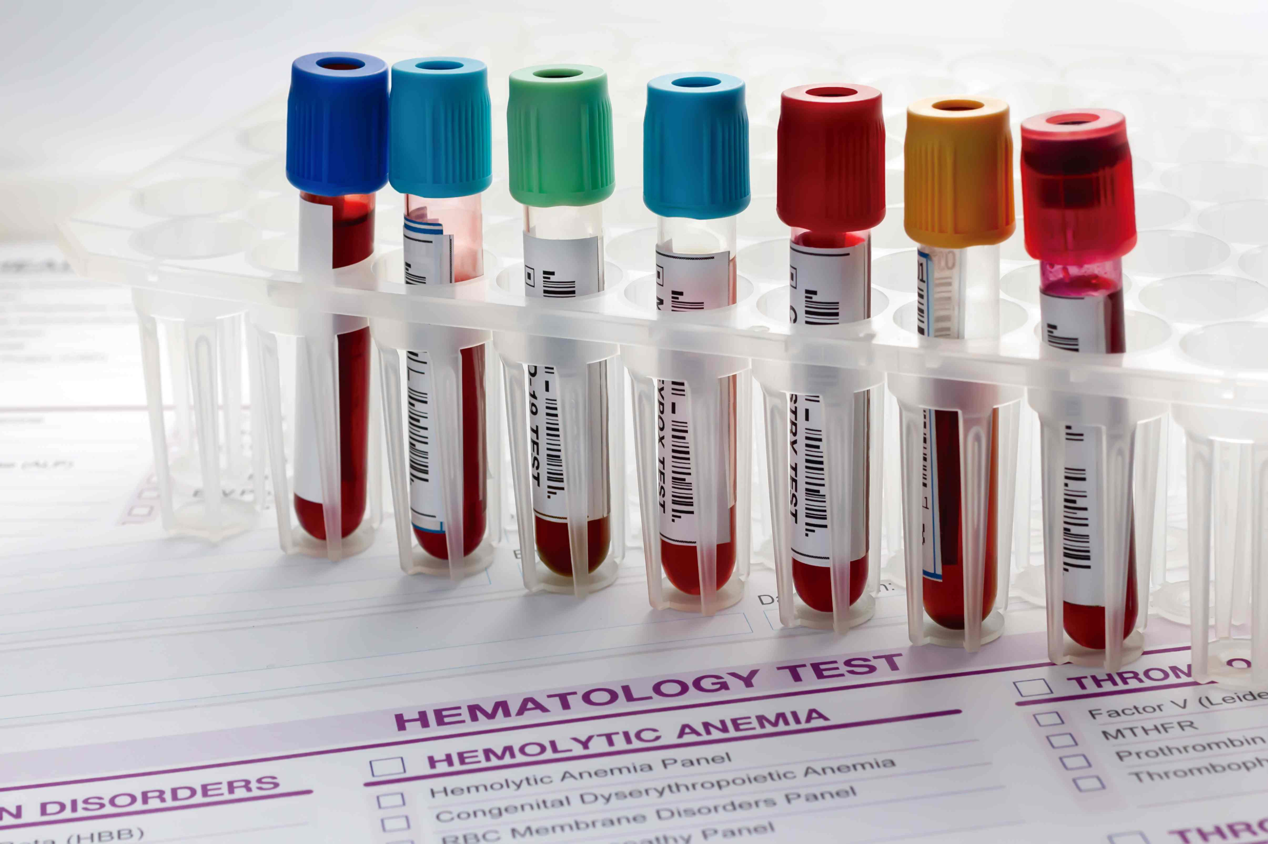 Seven vials of blood samples standing upright in a stand. Below the vials, there is a sheet that reads "hematology test", with various conditions and checkboxes.