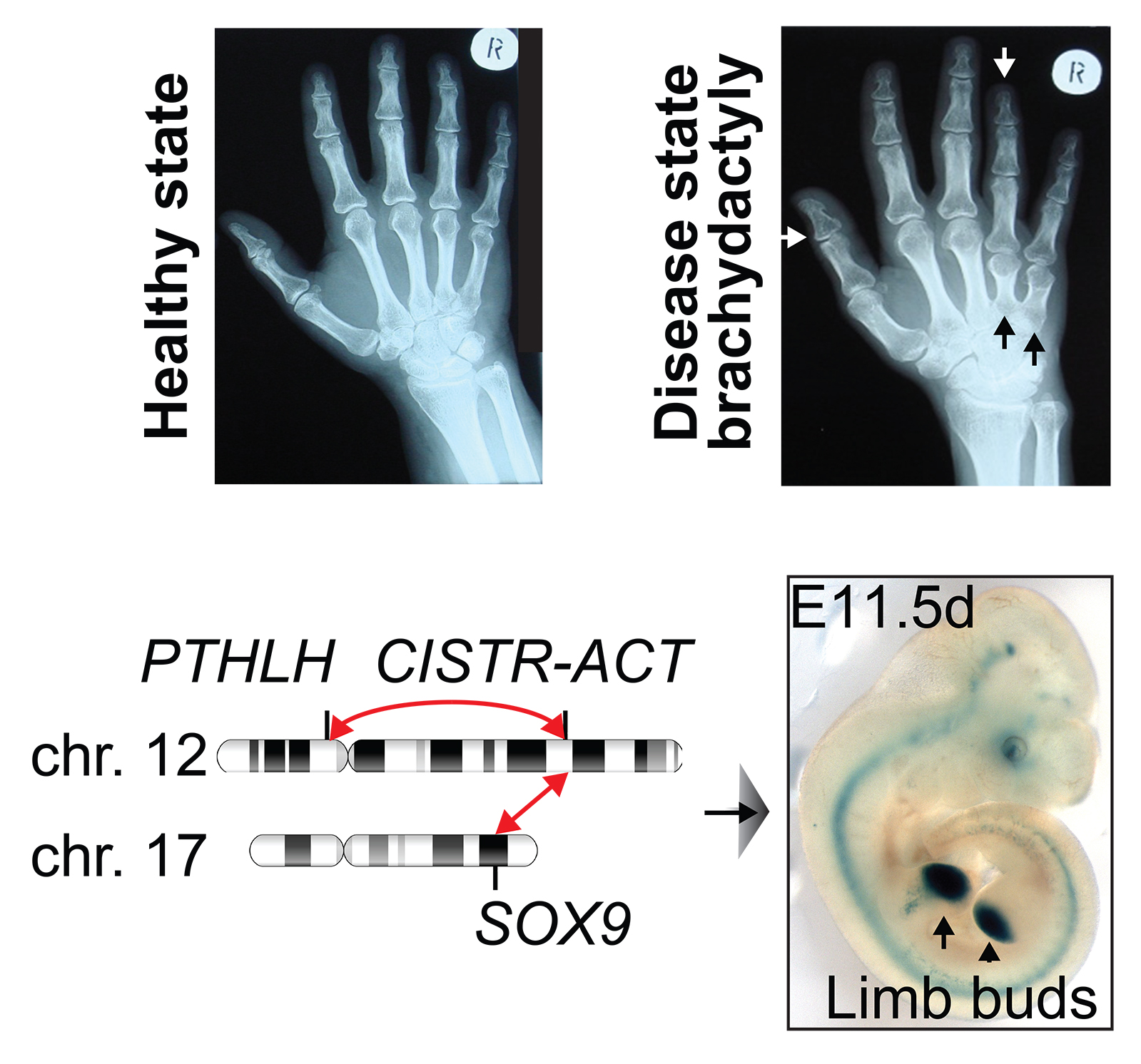 Hand roentgenograms show shortened fingers (brachydactyly), caused by misplaced inter-chromosomal interactions between the long non-coding RNA gene locus CISTR-ACT (chromosome 12) and the transcription factor SOX9 (chromosome 17).