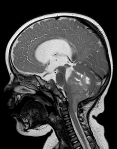 Poly Fossa ependymoma MRI screen