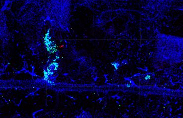 Immunofluorescence staining for F4/80+ macrophages and DAPI around GFP+ metastasis on spinal meninges of a Sleeping Beauty Patched1 Het mouse (zoomed regions)