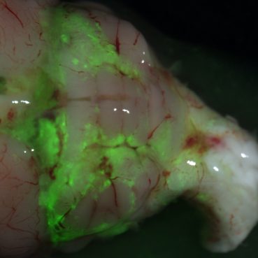 Med8A GFP+ medulloblastoma cells that attached and survived on the cerebellum after injection into the right lateral ventricle of a rat brain. Notice that a lot of the GFP+ cells are in contact/close to blood vessels.