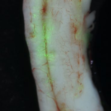 Spinal cord of a rat that was injected with Med8A GFP+ medulloblastoma cells in the lateral ventricle.