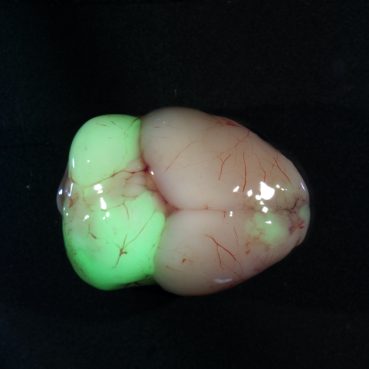 Medulloblastoma primary tumor in the cerebellum of a Sleeping Beauty Patched1 Het mouse model