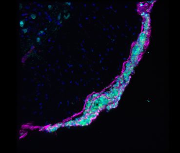 Confocal image of spinal cord cross-section labelled for nuclei (blue), neurons (cyan) and the leptomeninges (magenta). Math1-GFP metastatic tumour cells (green) reside on the surface of the spinal cord within the leptomeningeal space of the transgenic medulloblastoma mouse model.