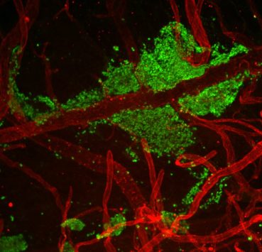 Confocal image of spinal meninges with Math1-GFP metastatic tumour cells (green) surrounding meningeal blood vessels (red) in a transgenic medulloblastoma mouse model.