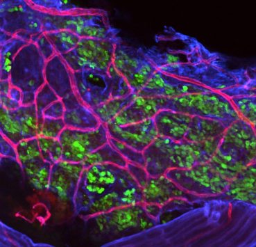 Confocal image of spinal meninges with Math1-GFP metastatic tumour cells (green) associating with a blood vessel network (blue and red) in a transgenic medulloblastoma model model.