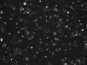 Patient-derived paediatric PFA ependymoma cell lines grown under hypoxic conditions display distinct morphologies (10X).