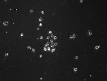 Patient-derived pediatric PFA ependymoma cell lines grown under hypoxic conditions display distinct morphologies (10X).