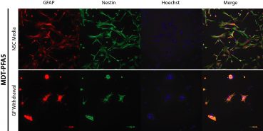 Immunofluorescence of brain tumour markers in PFA cells demonstrate differentiation upon growth factor withdrawal.
