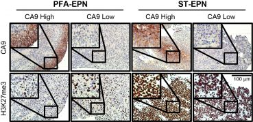Hypoxia is associated with decreased H3K27 trimethylation in biopsies of PFA tumour tissue.