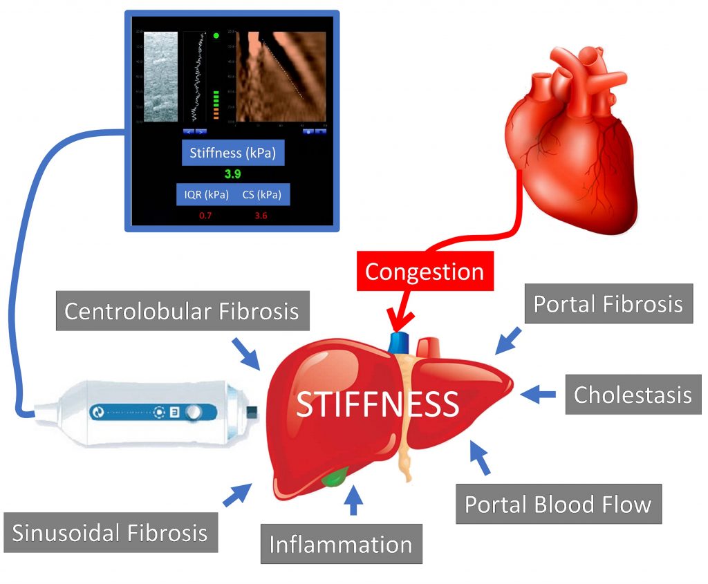 Factors that impact liver stiffness include Centrolobular fibrosis, portal fibrosis, cholestasis, portal blood flow, inflammation, sinusoidal fibrosis