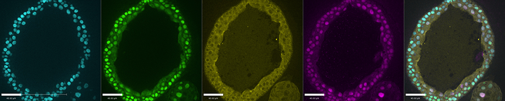 Human dF508 homozygous CF iPS-derived airway organoid after treatment with a market drug OrkambiTM resulted in swelling of the organoid and modest CFTR expression in the luminal surface of the epithelium. TTF1 (lung marker) in green, CFTR in yellow, SOX2 (proximal epithelia marker) in magenta.