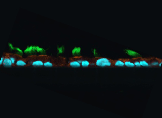 Pluripotent stem cell-derived airway epithelia in air liquid interface. Green marks cilia orange marks CFTR the channel. CFTR expression on the apical membrane of ciliated cells helps mucociliary functions to clear pathogens out of the airways.
