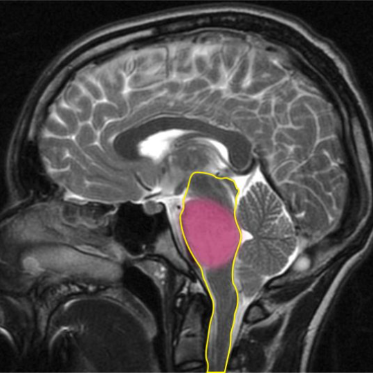 Brain MRI (sagittal view) showing DIPG. The brainstem is outlined in yellow, the DIPG tumour is highlighted in pink.