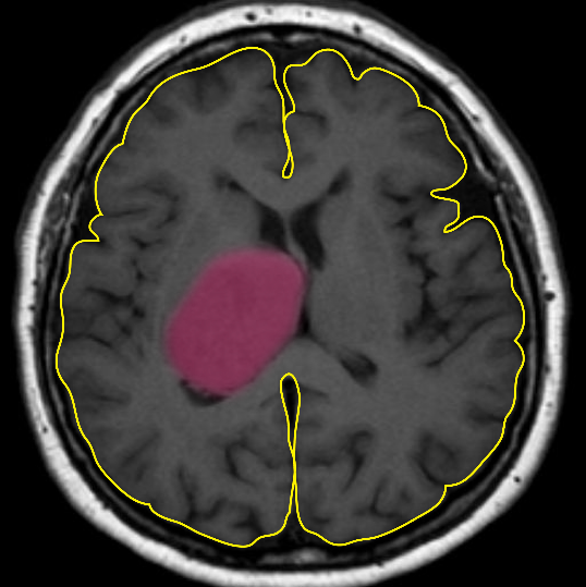 Brain MRI (transverse view) showing a brain tumour. The cerebrum is outlined in yellow, the tumour (glioblastoma) is highlighted in pink.